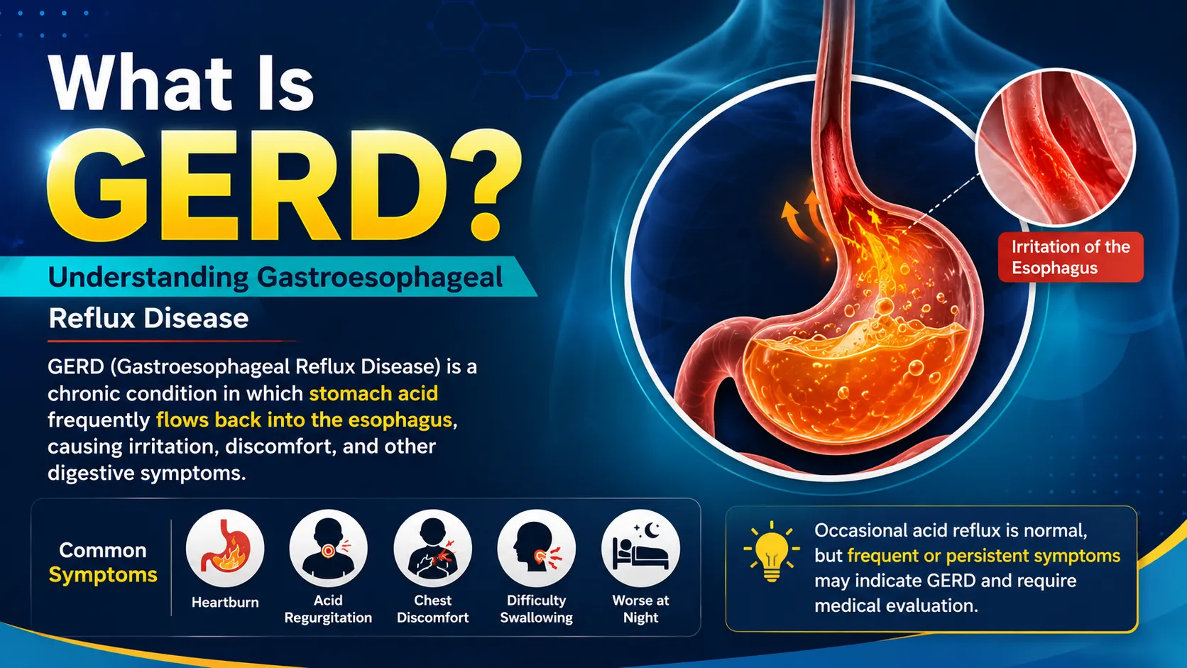 What Is GERD
